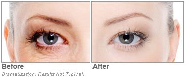 Revitol Eye Cream Results